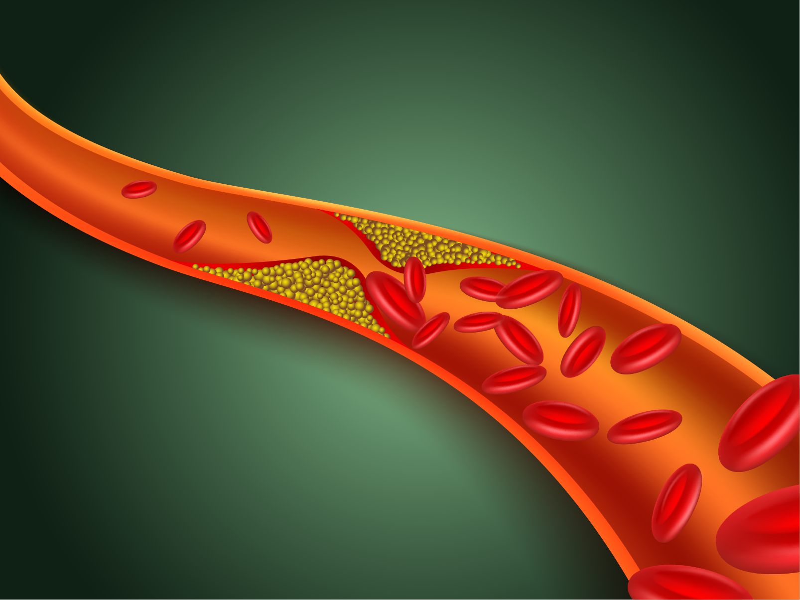 Can CBD oil treat high cholesterol levels?